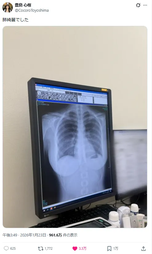 写真偶像丰岛心樱上传胸部X光照 浮现的胸部线条让网友直喊:没想过连X光都这么色…